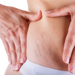 Cara Menghilangkan Selulit (Stretch Mark) Di Perut, Paha & Betis Dengan Cepat