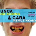 4 Punca Gigi Kuning & Cara Memutihkannya